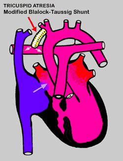 Tricuspid Atresia